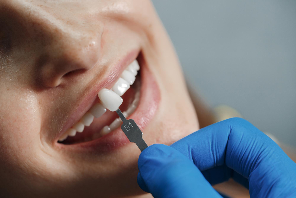 How Long Does a Dental Crown Last