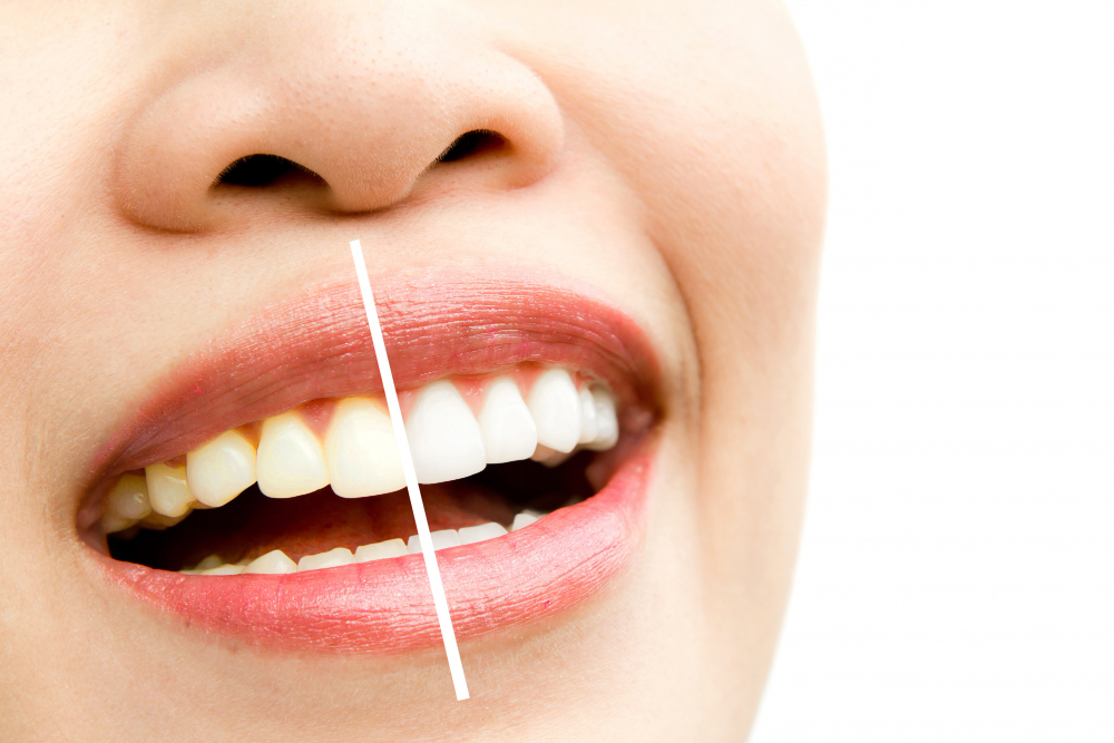 Best Teeth Whitening Toothpaste