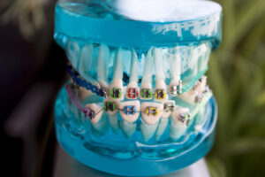 Invisalign vs Braces Cost Comparison