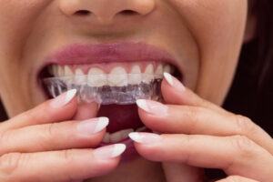 can you eat food with Invisalign aligners